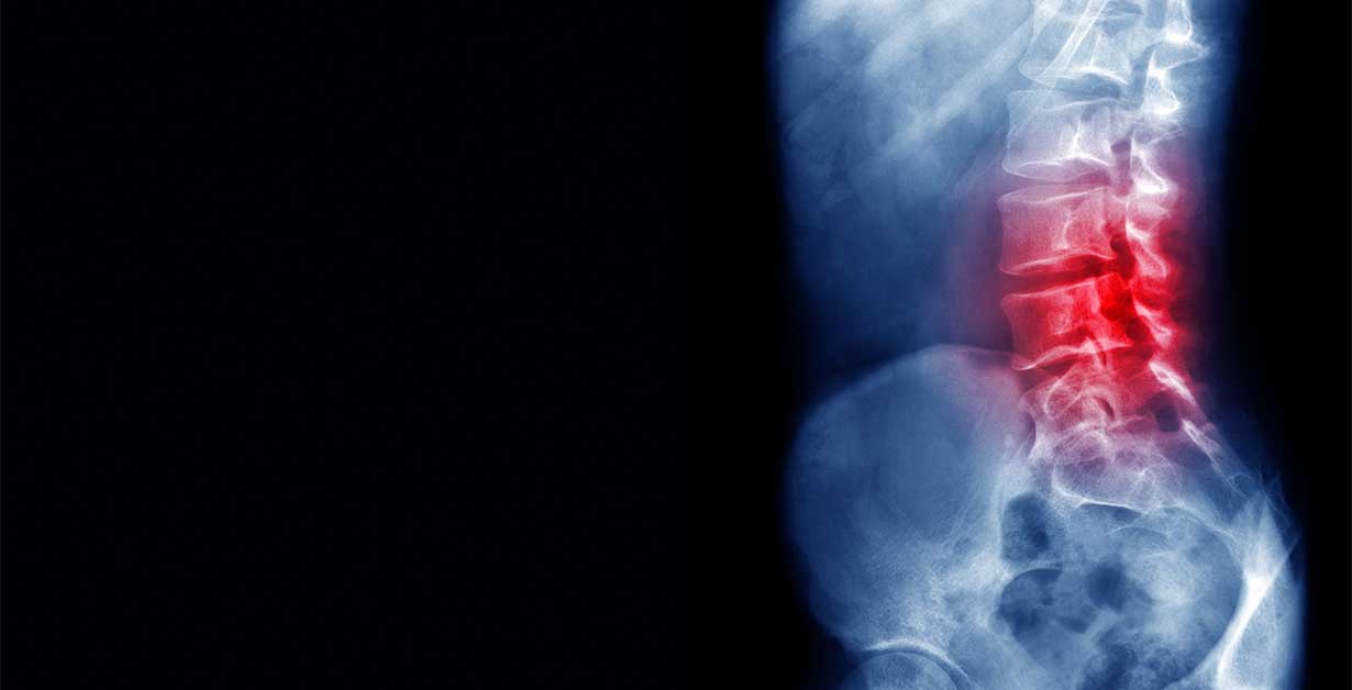 Tethered Cord Syndrome Causes, Symptoms, and Treatments